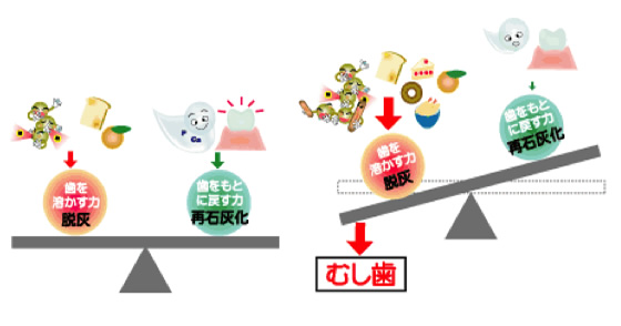  むし歯