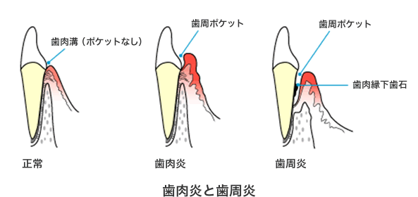 歯肉炎・歯周炎