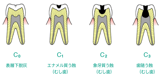 むし歯