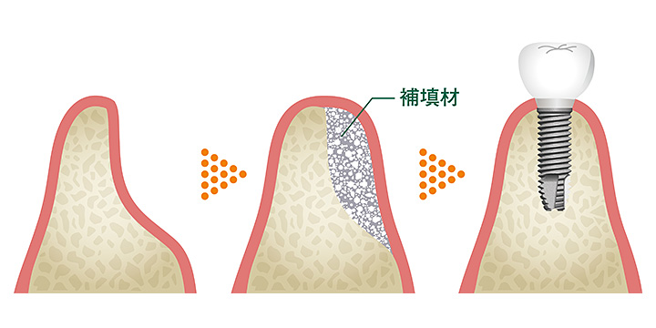 骨造成イメージ図
